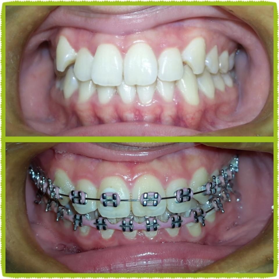 Metal braces in Makati Dental Clinic